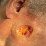 Mohs Face Patient 22 Thumbnail After