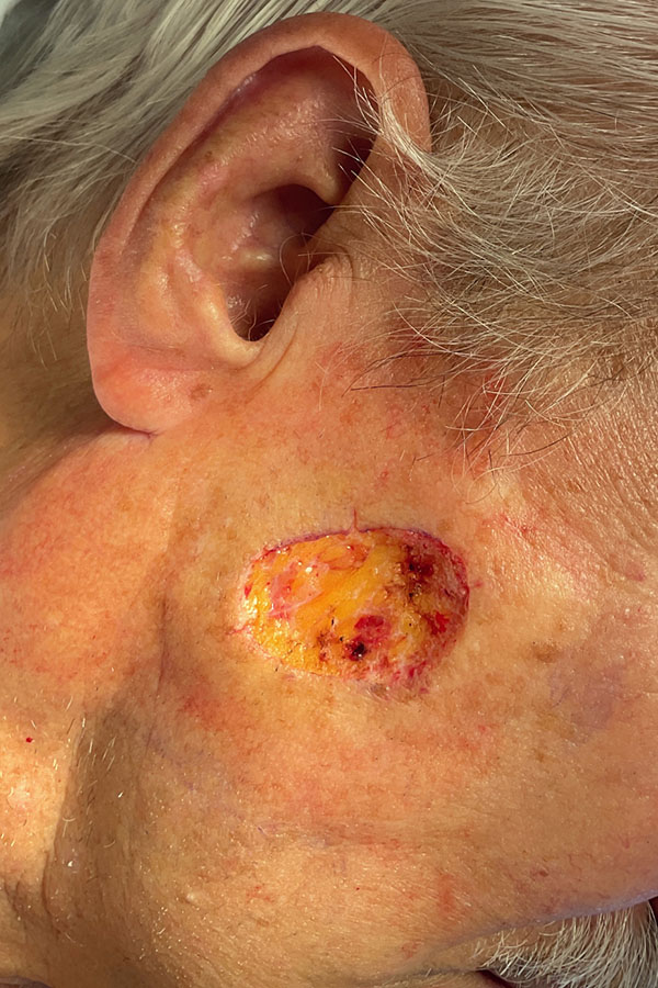 Mohs Face Patient 22 After