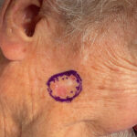 Mohs Face Patient 22 Thumbnail Before