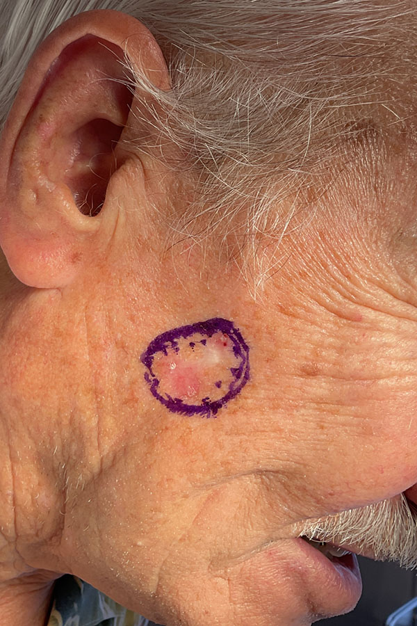 Mohs Face Patient 22 Before