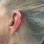 Mohs Ear Patient 14 Thumbnail Before