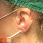 Mohs Ear Patient 14 Thumbnail After