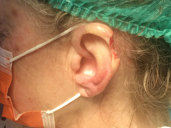 Mohs Ear Patient 14 After