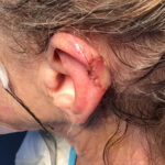 Mohs Ear Patient 14 Thumbnail Before - 2
