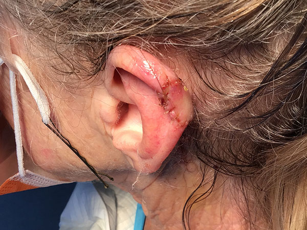 Mohs Ear Patient 14 Before - 2