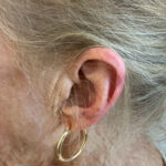 Mohs Ear Patient 14 Thumbnail After - 2