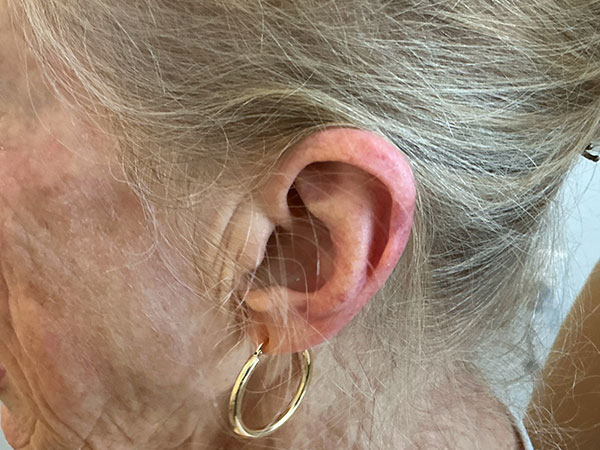 Mohs Ear Patient 14 After - 2