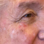 Mohs Eye Patient 09 Thumbnail Before
