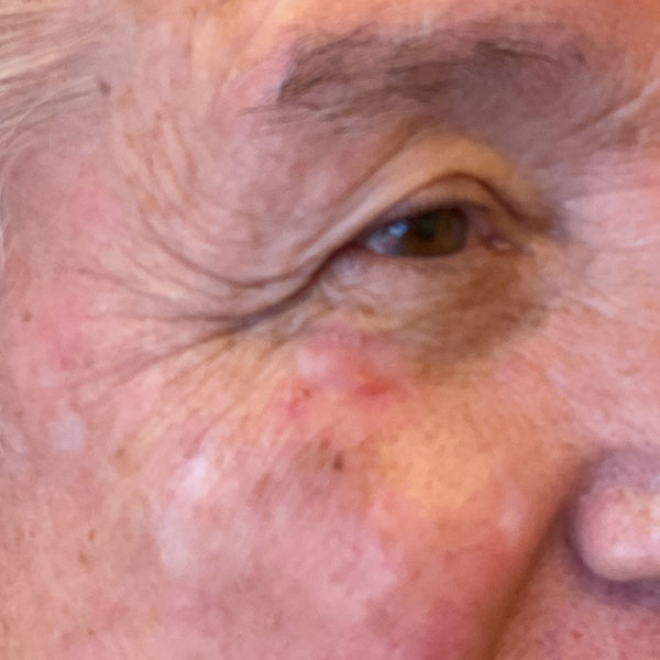 Mohs Eye Patient 09 Before