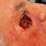 Mohs Eye Patient 09 Thumbnail After