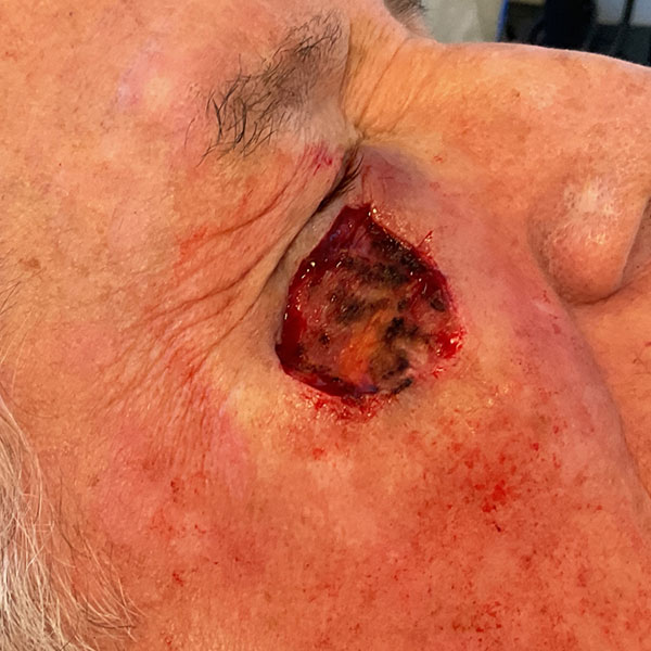 Mohs Eye Patient 09 After