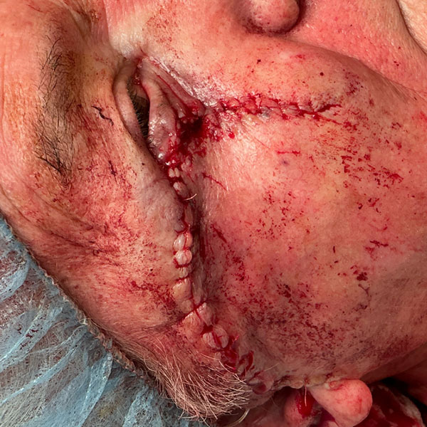 Mohs Eye Patient 09 Before - 2