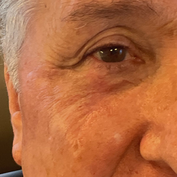 Mohs Eye Patient 09 After - 2