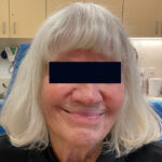 Mohs Nose 31 Thumbnail Before