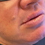 Mohs Lips Patient 16 Thumbnail Before