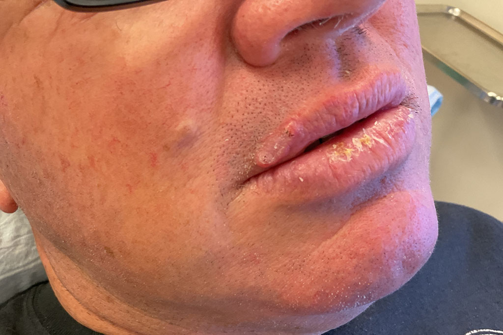 Mohs Lips Patient 16 Before