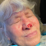 Mohs Nose 31 Thumbnail After