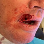 Mohs Lips Patient 16 Thumbnail After