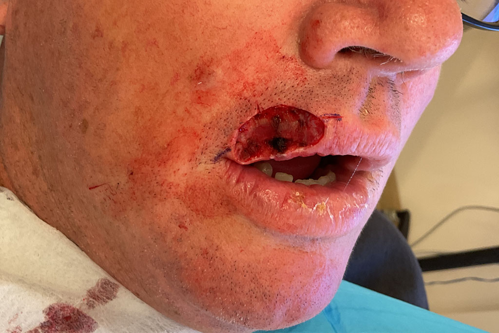 Mohs Lips Patient 16 After