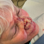 Mohs Nose 31 Thumbnail Before - 2