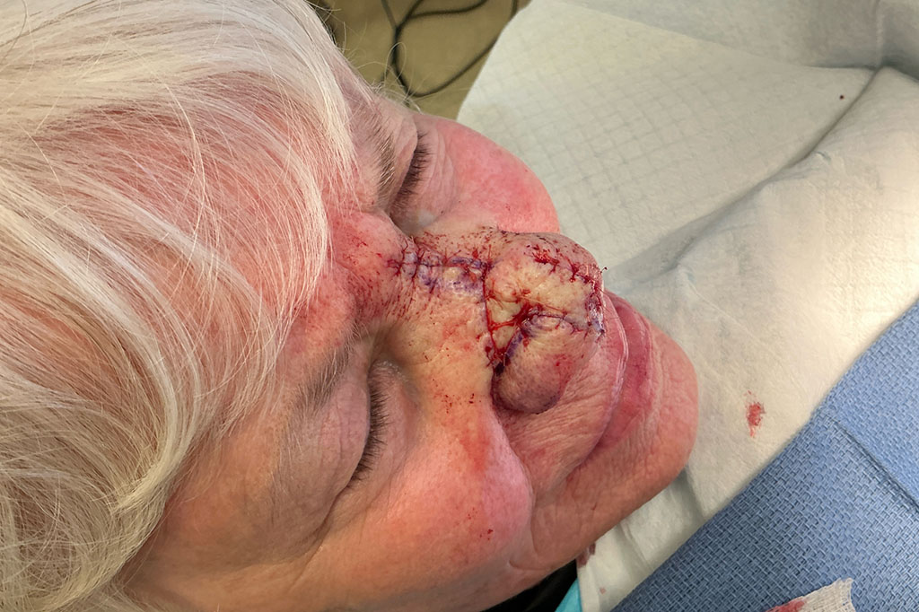 Mohs Nose 31 Before - 2