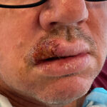 Mohs Lips Patient 16 Thumbnail Before - 2