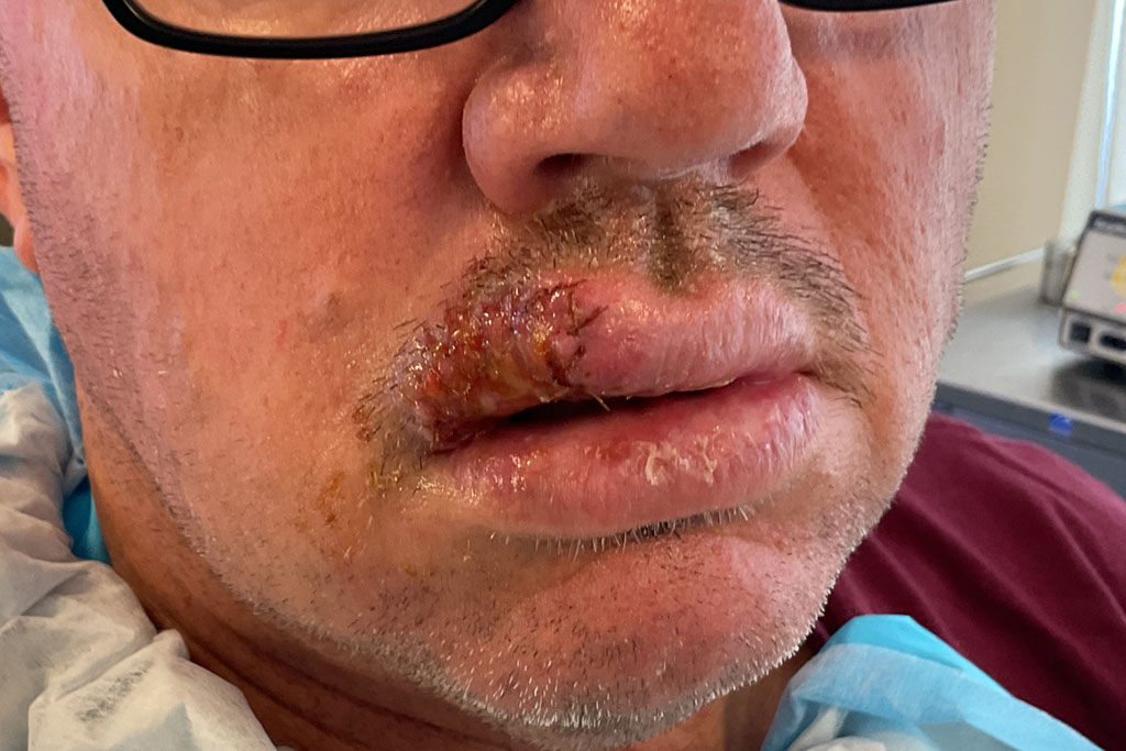 Mohs Lips Patient 16 Before - 2