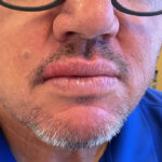 Mohs Lips Patient 16 Thumbnail After - 2