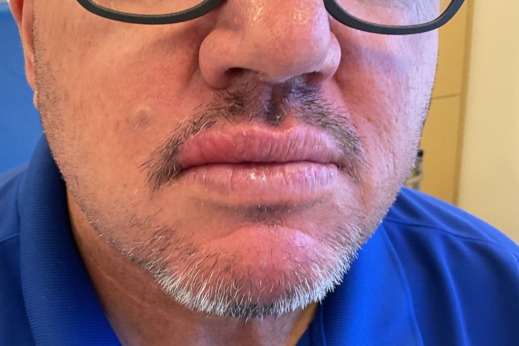 Mohs Lips Patient 16 After - 2