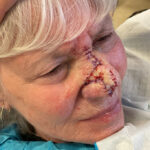 Mohs Nose 31 Thumbnail After - 2