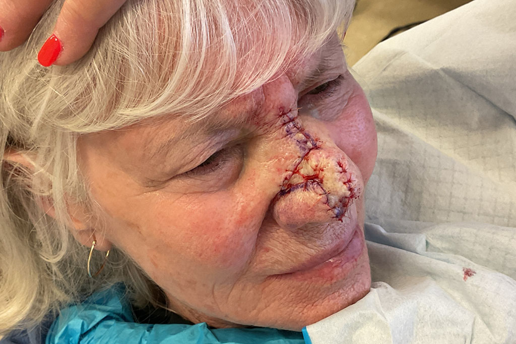 Mohs Nose 31 After - 2