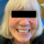 Mohs Nose 31 Thumbnail Before - 3