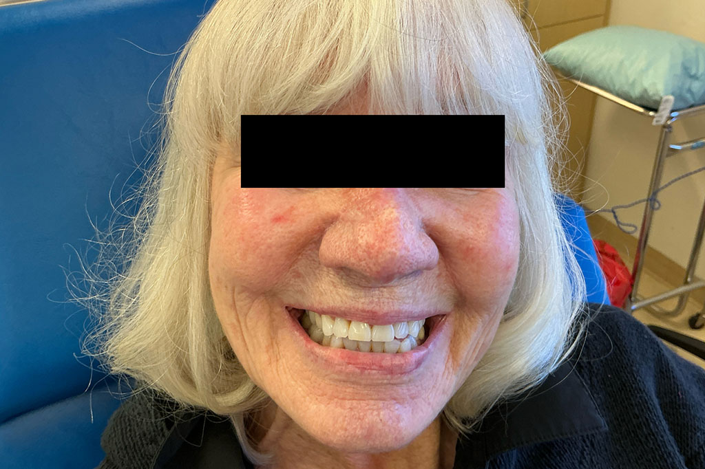 Mohs Nose 31 Before - 3