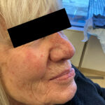 Mohs Nose 31 Thumbnail After - 3