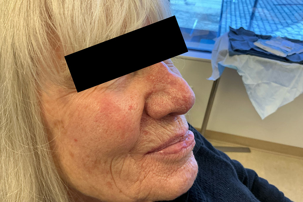 Mohs Nose 31 After - 3